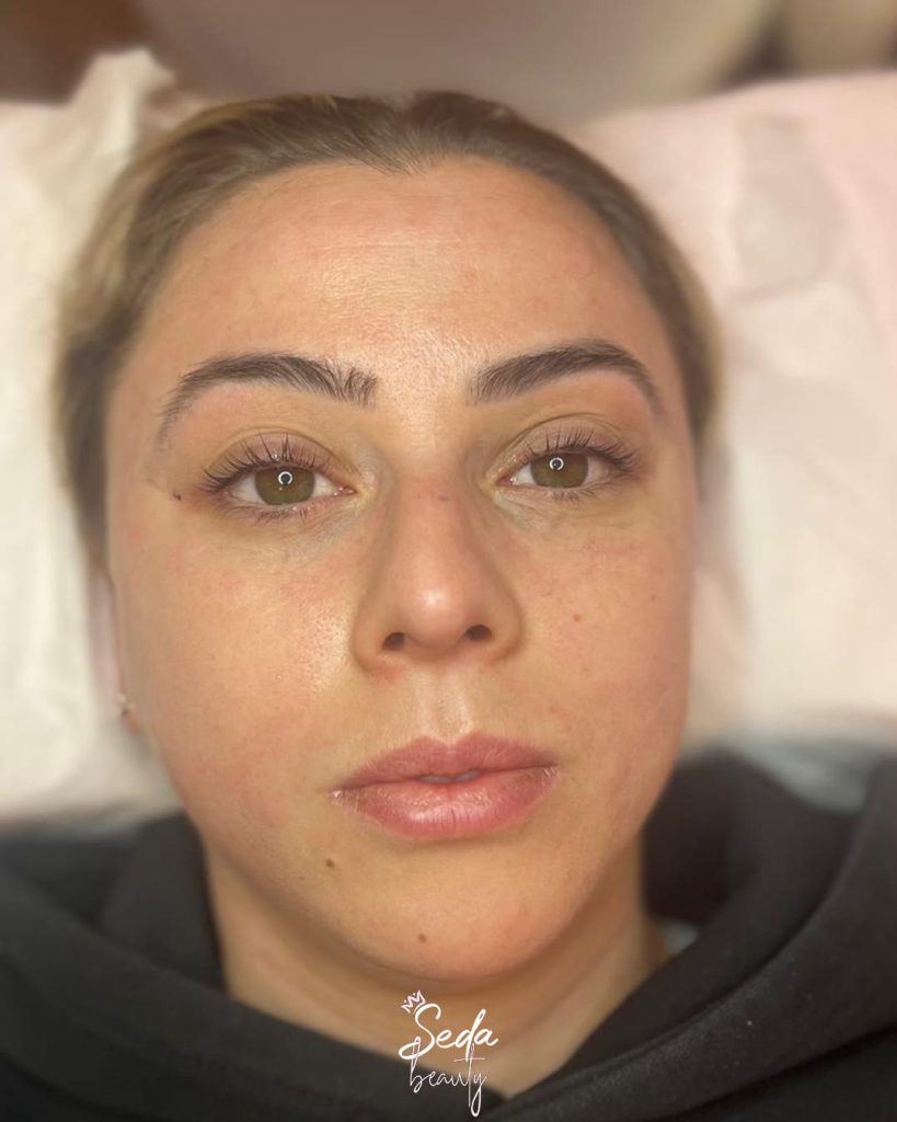 Laser hair removal for face targets fine hairs, offering long lasting results and a clearer complexion.