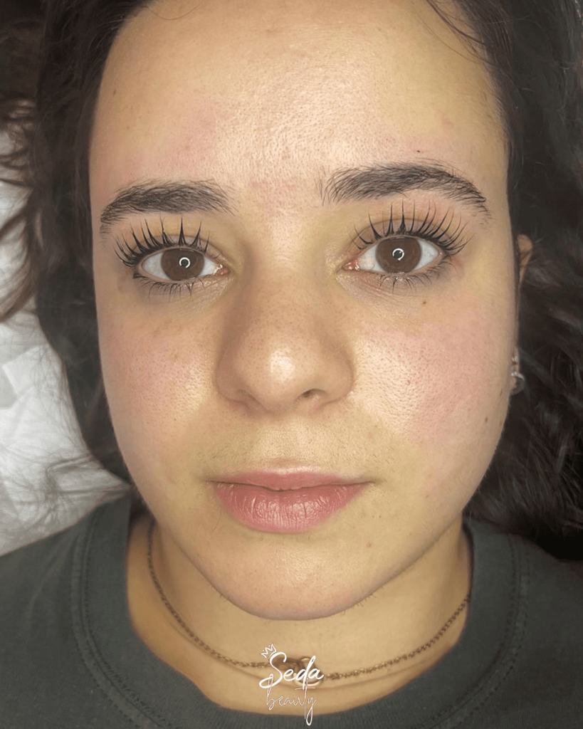 Facial hair removal methods including waxing and laser treatment for smooth and clear skin results.